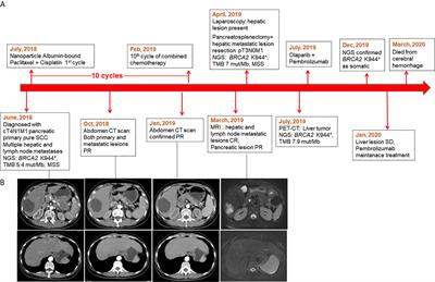 The Efficacy of Combined Cisplatin and Nanoparticle Albumin-Bound Paclitaxel in a Stage IV Pancreatic Squamous Cell Carcinoma Patient With a Somatic BRCA2 Mutation: A Case Report